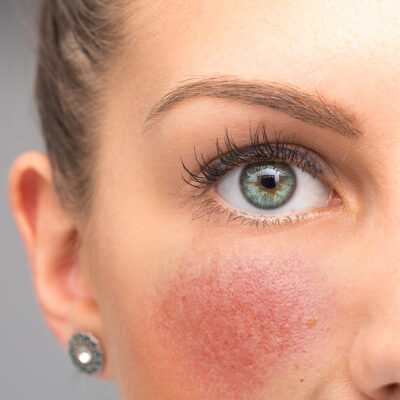 BioRosacea Anti-Redness Gel