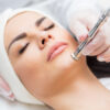 Microdermabrasion Treatment
